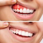 3 Signs You Need Professional Treatment for Gum Disease