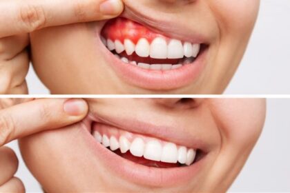 3 Signs You Need Professional Treatment for Gum Disease