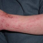 Identifying Allergic Reactions in Children and Their Management