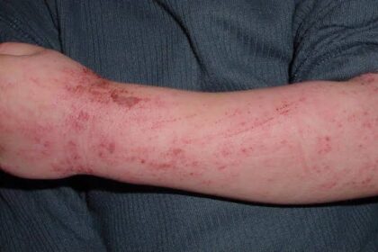 Identifying Allergic Reactions in Children and Their Management