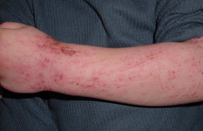Can Allergy Shots Help With Environmental Allergies?