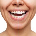 Post-Treatment Care for New Veneers