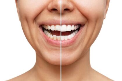 Post-Treatment Care for New Veneers
