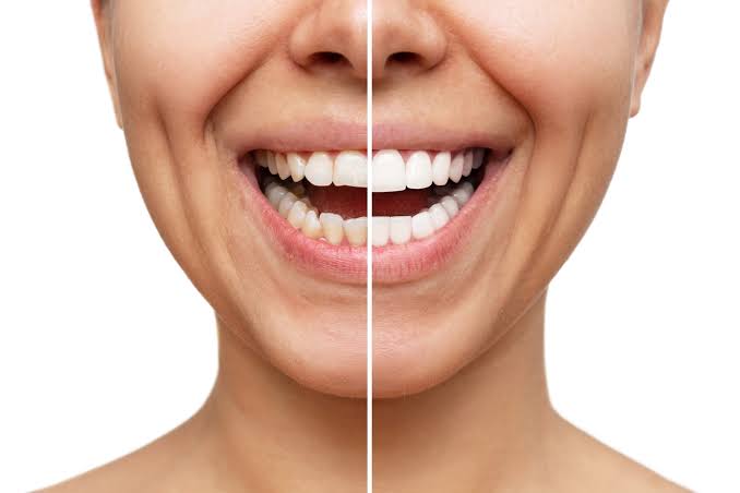 Post-Treatment Care for New Veneers
