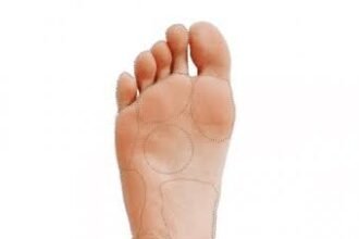 Preventing Plantar Warts