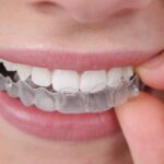 The Impact of Invisalign on Your Daily Life