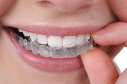 The Impact of Invisalign on Your Daily Life