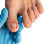 Understanding How to Prevent Fungal Nails