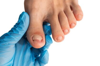 Understanding How to Prevent Fungal Nails