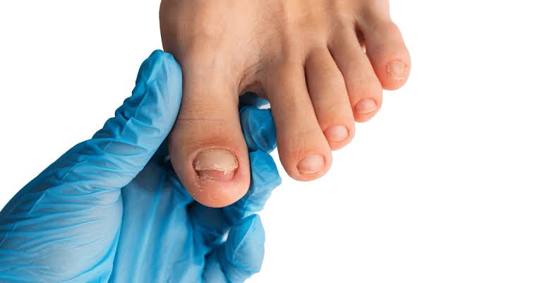 Understanding How to Prevent Fungal Nails