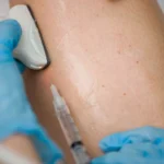 Signs That Help You Identify Varicose Veins