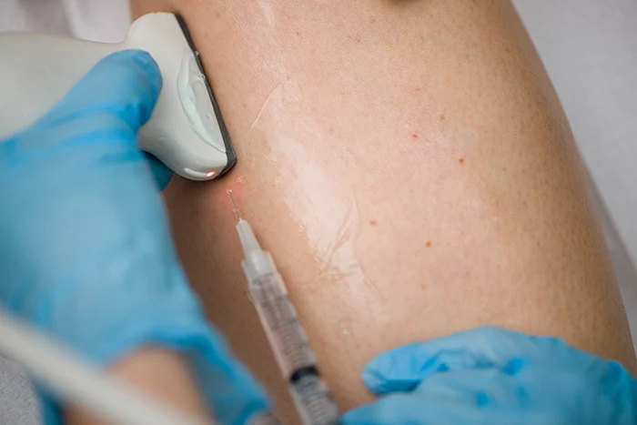 Signs That Help You Identify Varicose Veins