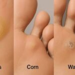 Effective Treatment Options Available for Plantar Warts