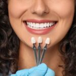 The Advantages of Choosing Veneers