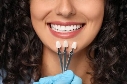 The Advantages of Choosing Veneers